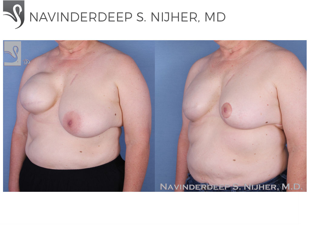 Breast Reconstruction After Breast Augmentation, Blog