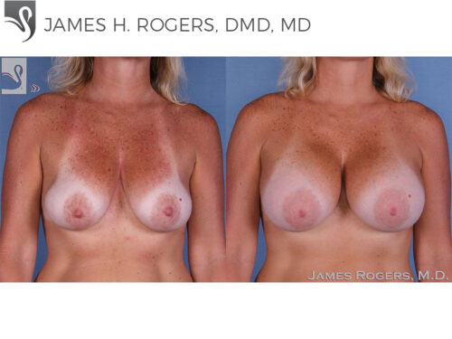 Breast Augmentation Case #12225 (Image 1)