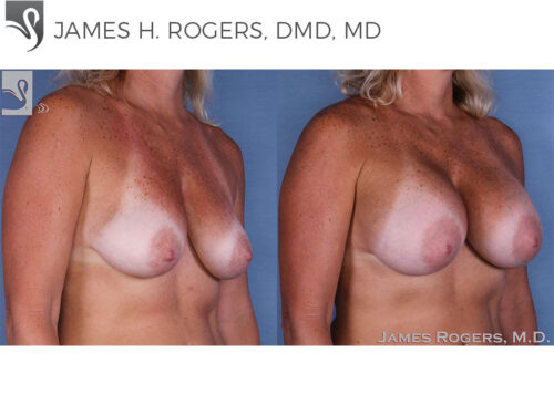 Breast Augmentation Case #12225 (Image 2)
