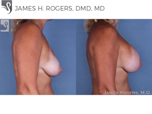 Breast Augmentation Case #12225 (Image 3)