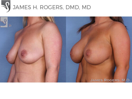 Breast Augmentation Case #47717 (Image 2)