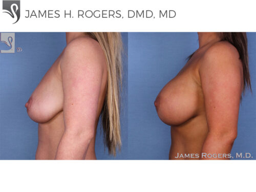 Breast Augmentation Case #47717 (Image 3)