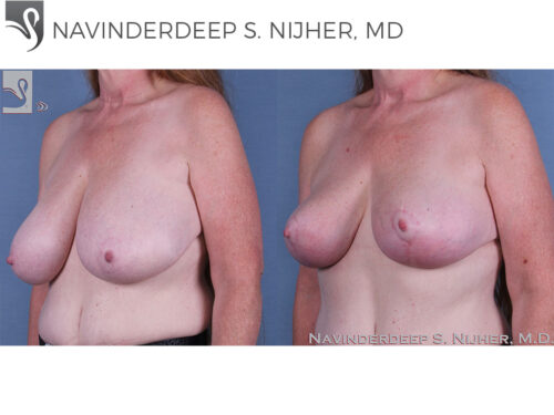 Female Breast Reduction Case #62944 (Image 2)