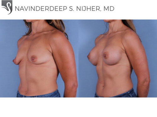 Breast Augmentation Case #62289 (Image 2)