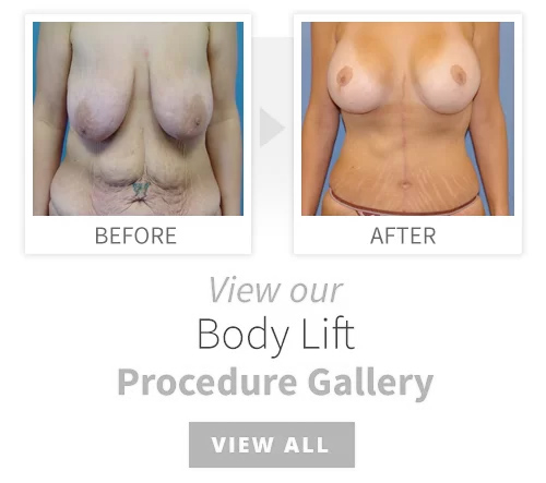 Body Lift Surgery - Ocala Plastic Surgery