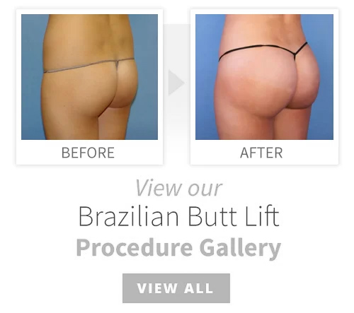 how much does a brazilian butt lift cost