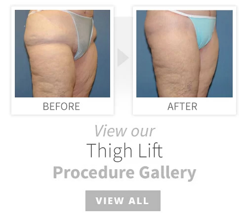 Thigh Lift Scars After 1 Year