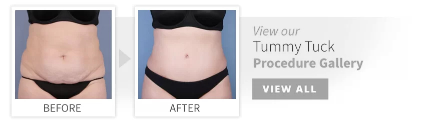 Tummy Tuck - Abdominoplasty - Ocala Plastic Surgery