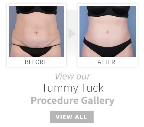 Tummy Tuck - Abdominoplasty - Ocala Plastic Surgery