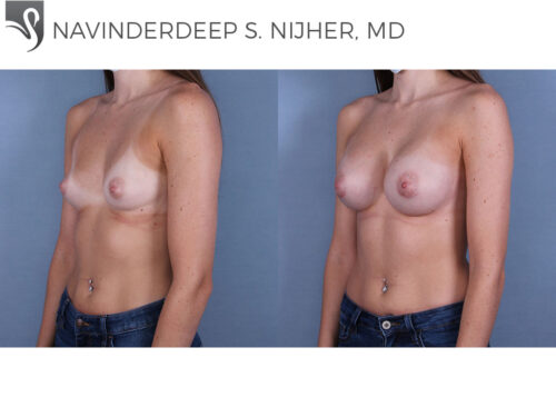 Breast Augmentation Case #69194 (Image 2)