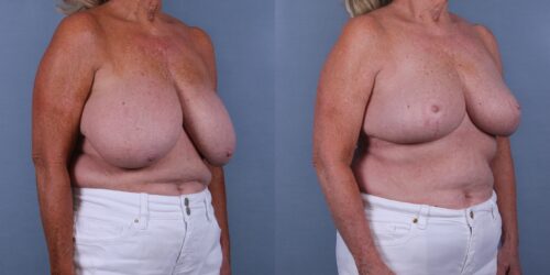 Female Breast Reduction Case #72270 (Image 2)