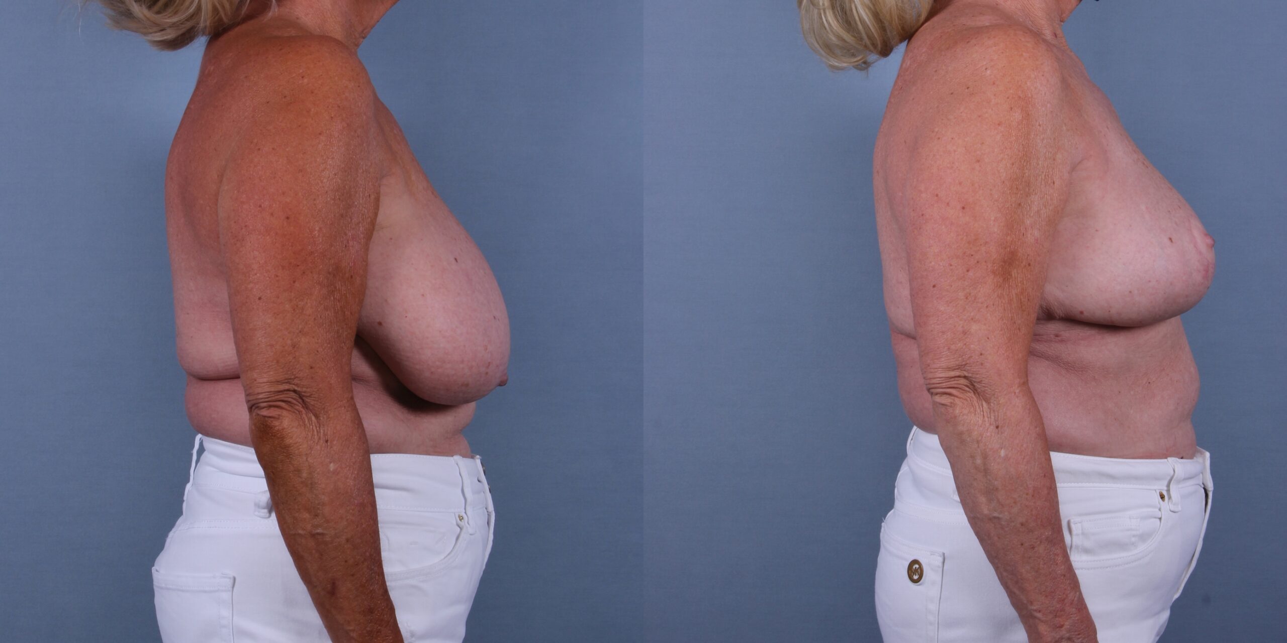 breast reduction surgery near me free consultation