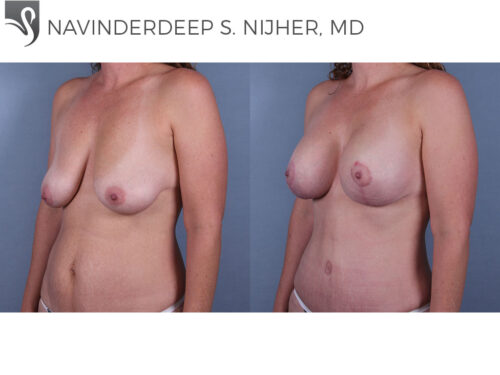 Breast Augmentation with Mastopexy (Breast Lift) Case #72926 (Image 2)