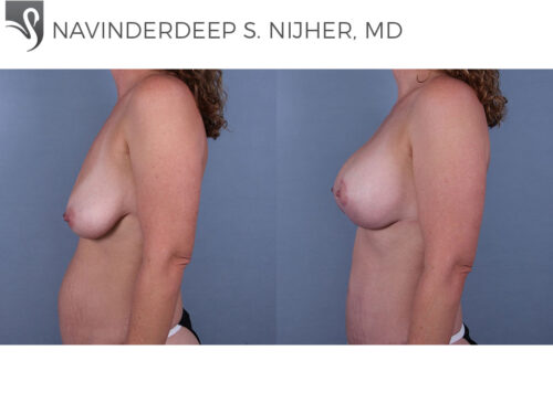 Breast Augmentation with Mastopexy (Breast Lift) Case #72926 (Image 3)
