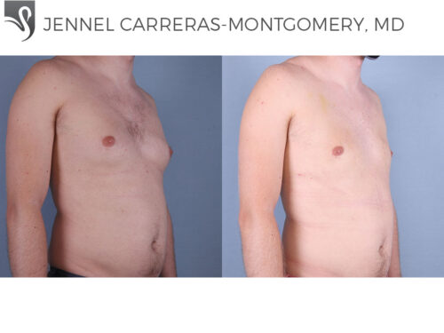 Male Breast Reduction Case #70040 (Image 2)