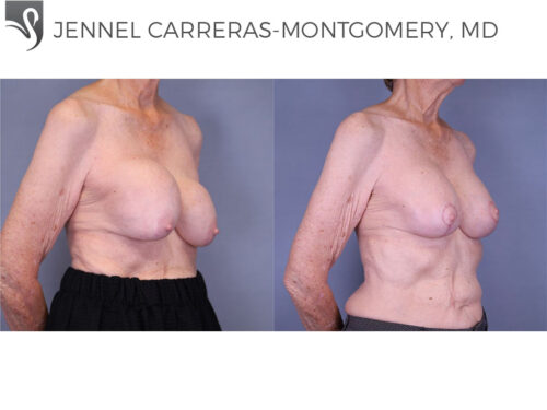 Breast Revisions Case #70432 (Image 2)