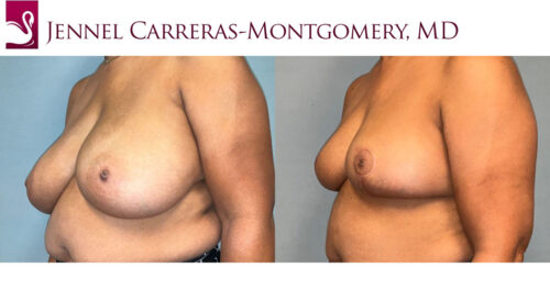 Female Breast Reduction Case #77574 (Image 2)