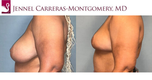 Female Breast Reduction Case #77574 (Image 3)