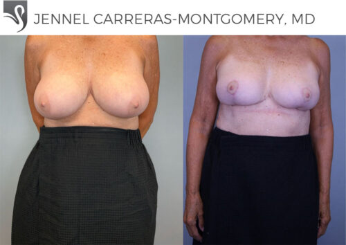 Female Breast Reduction Case #79780 (Image 1)