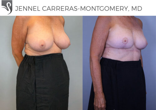 Female Breast Reduction Case #79780 (Image 2)