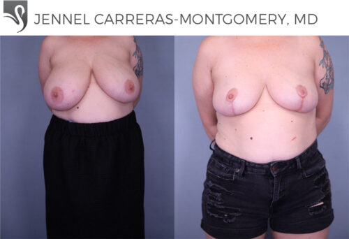 Female Breast Reduction Case #79989 (Image 1)