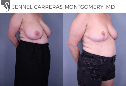 Female Breast Reduction Case #79989 (Image 2)